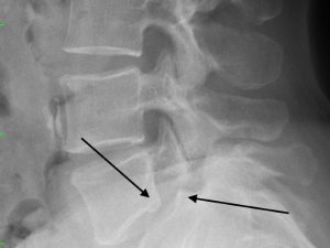 Spondilolistesi Brescia